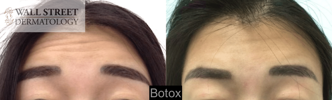 Botox to Forehead Before and After (3)