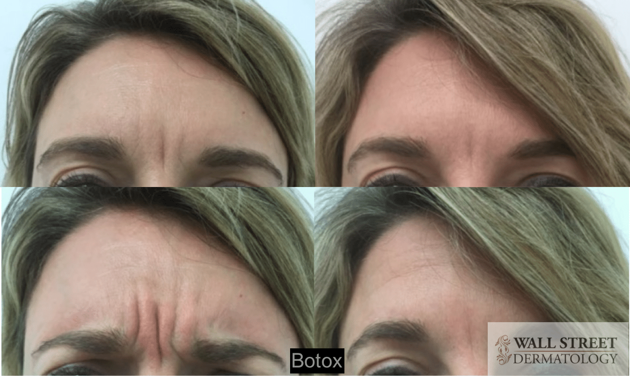 Botox to Glabella Before and After (2)