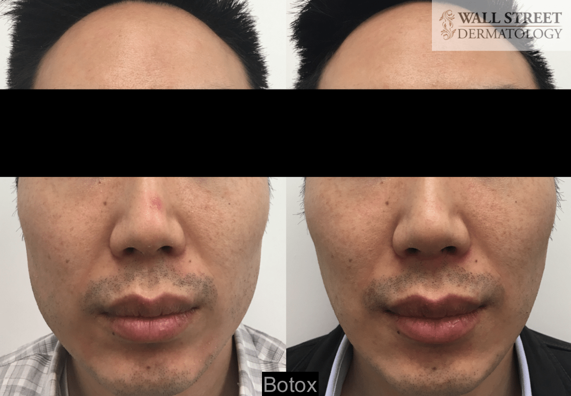 Botox to Jaw Muscles Before and After (3)