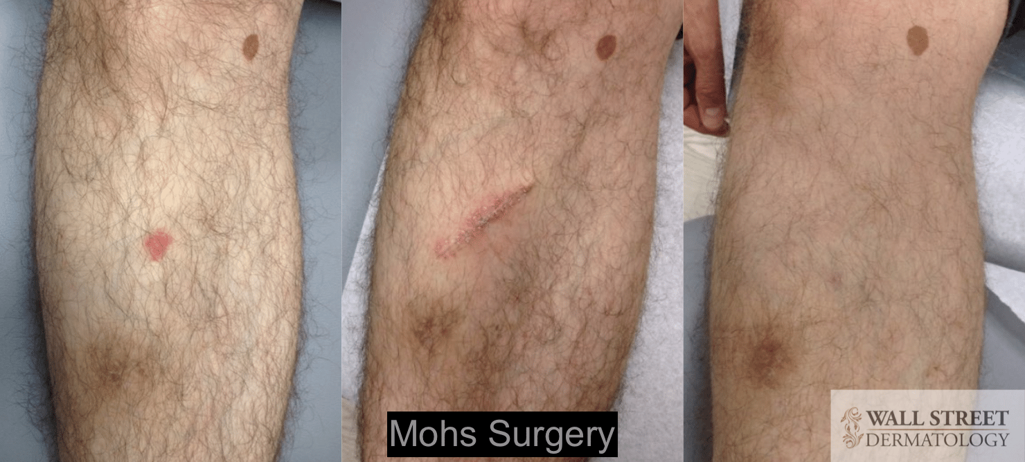 Before and After Dermatology Photo Gallery | Wall Street ...