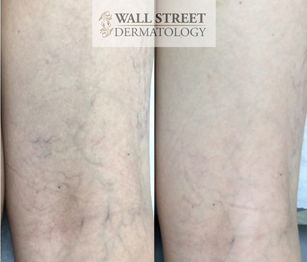 Sclerotherapy Before and After