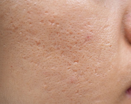 acne scarring