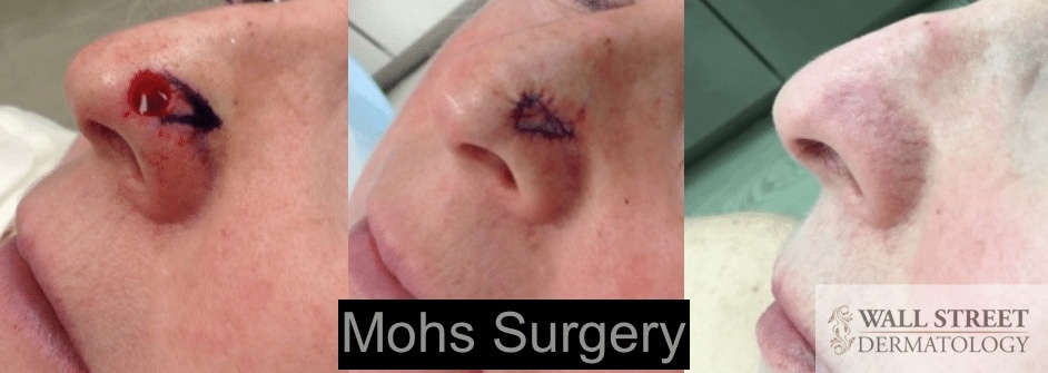 basal cell carcinoma nose scar