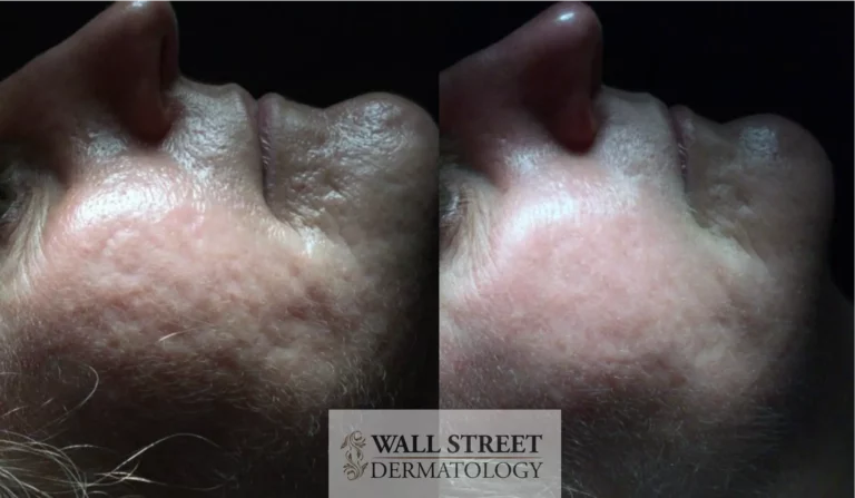 Before and After Acne Scar Subcision on the Cheeks