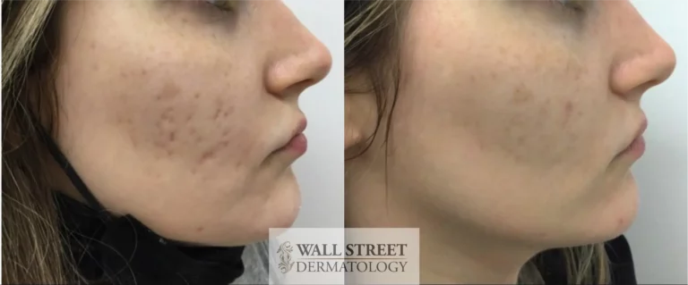 Before and After Acne Scar Subcision and Laser Treatment