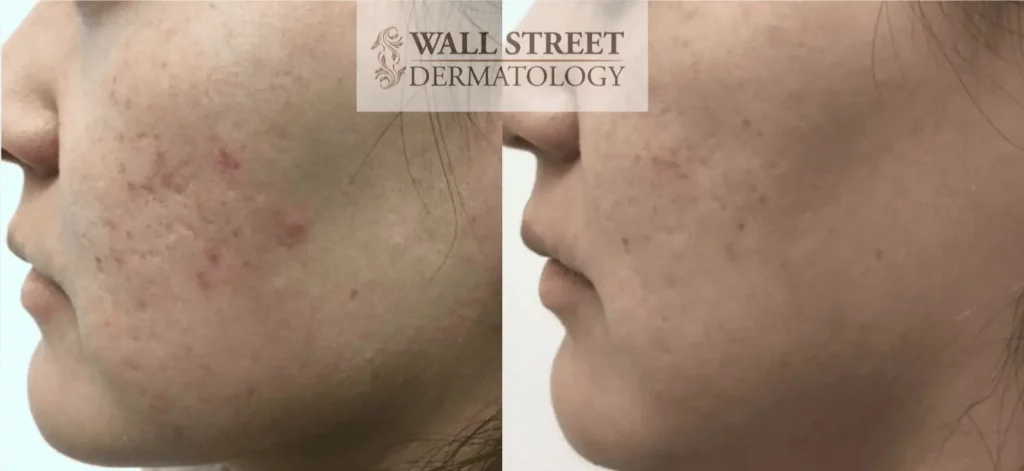 Before and After Acne Scar Subcision on Cheeks