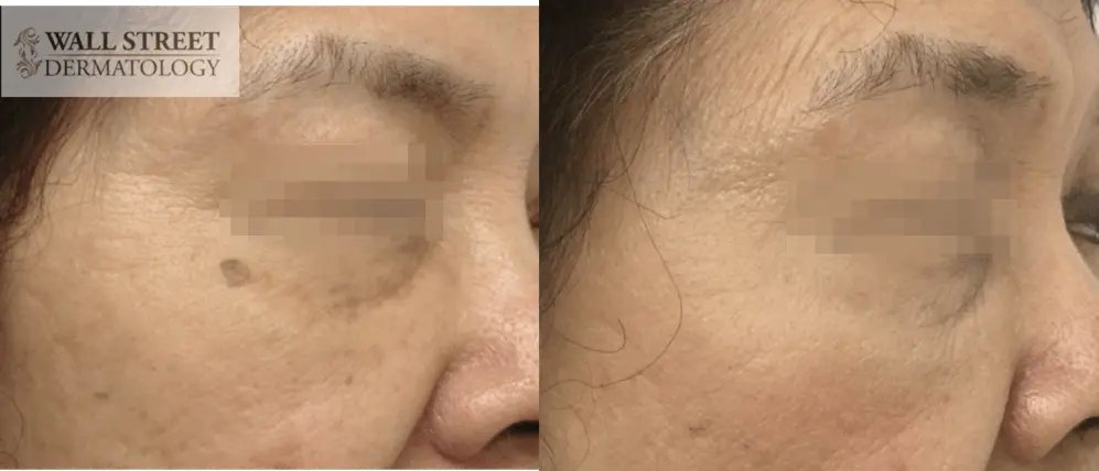 Brown spot removal via hyfrecation