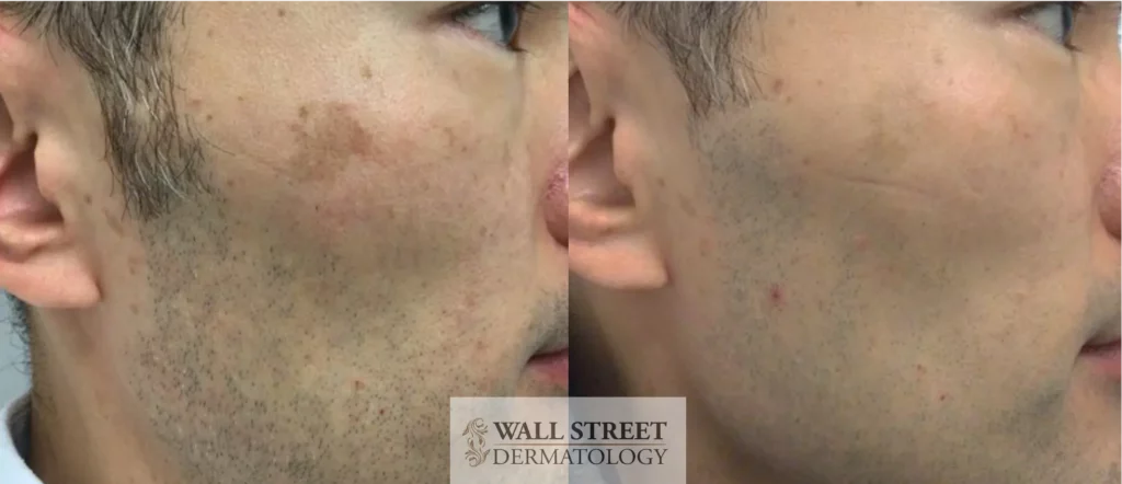 Laser Brown Spot Removal