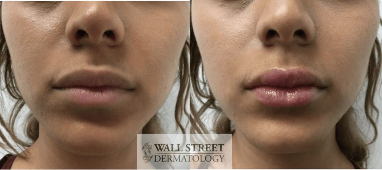 Before and After Cosmetic Filler Injections by Dr. Julia Tzu at Wall Street Dermatology