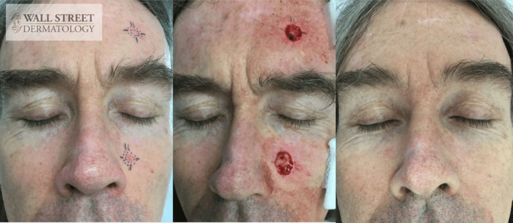 Mohs Surgery Before and After