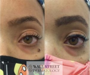Cosmetic Surgical Mole Removal Before and After