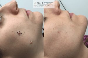 Mole Removal Before and After