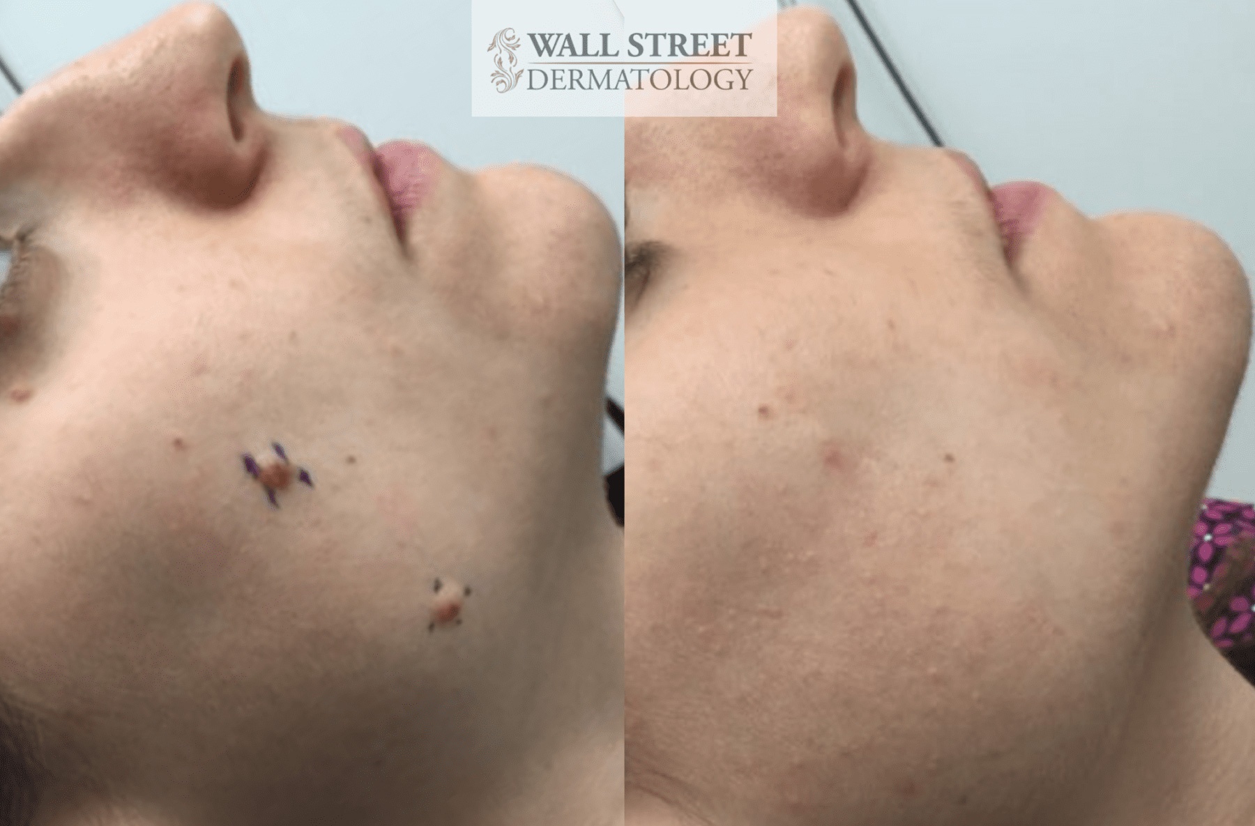 Mole Removal NYC   Wall Street Dermatology