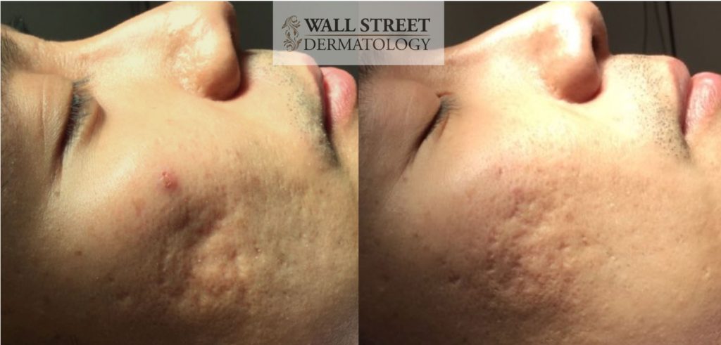 Acne Scar Subcision with Filler Before and After