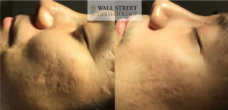 Before and After Acne Scar Subcision on Cheeks