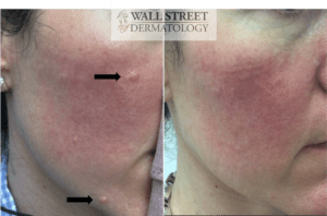 cosmetic mole removal before and after