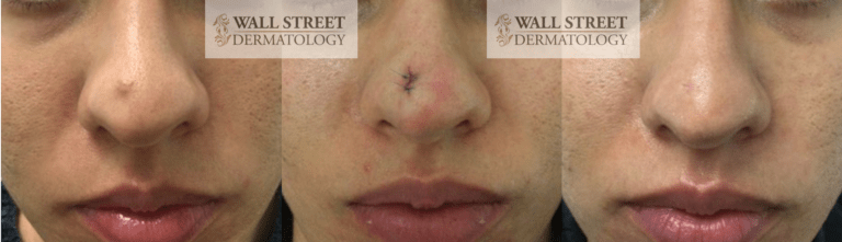 Cosmetic surgical mole removal before and after