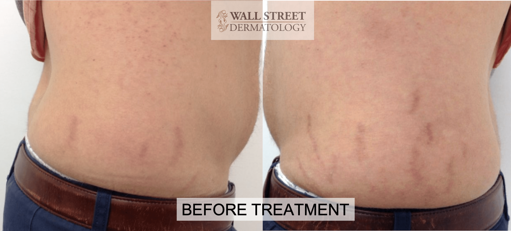 Laser Treatment - Wall Street Dermatology