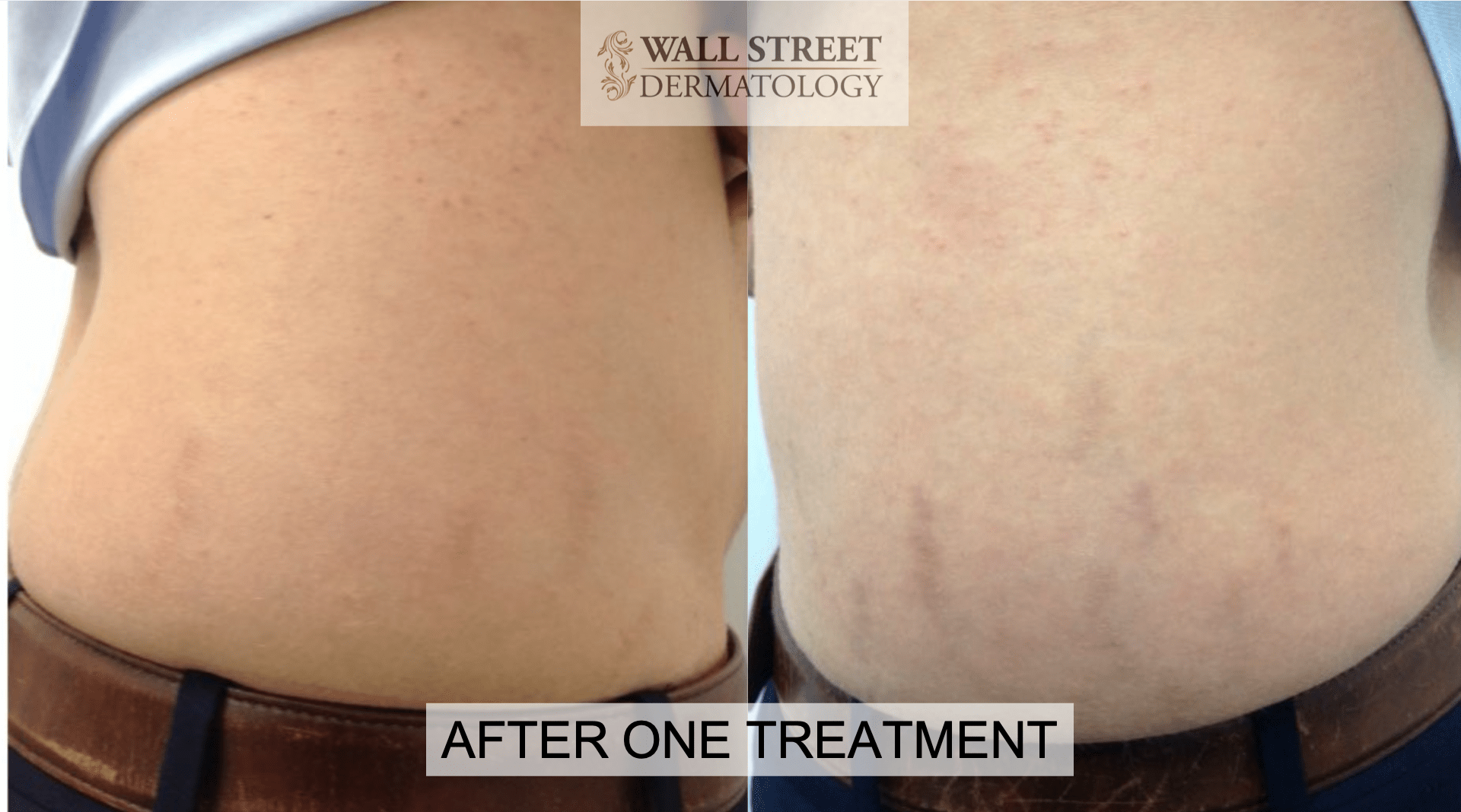 Laser Skin Resurfacing Wall Street Dermatology 