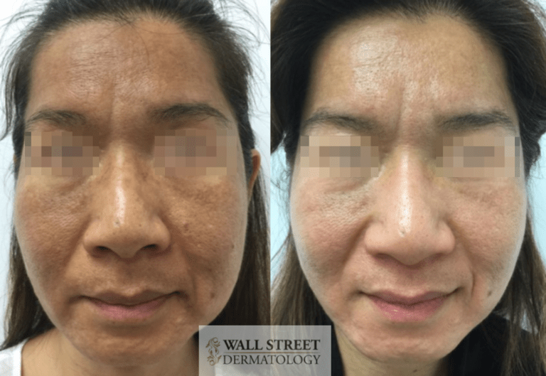 Before and after laser melasma treatment, front view, by Dr. Julia Tzu at Wall Street Dermatology