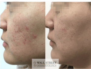 acne scar treatment