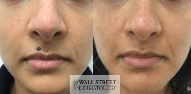 Cosmetic surgical mole removal above lip before and after
