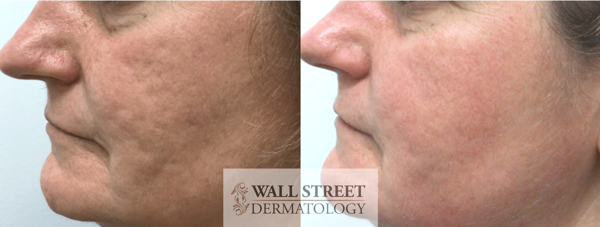 Acne Scar Subcision NYC Wall Street Dermatology