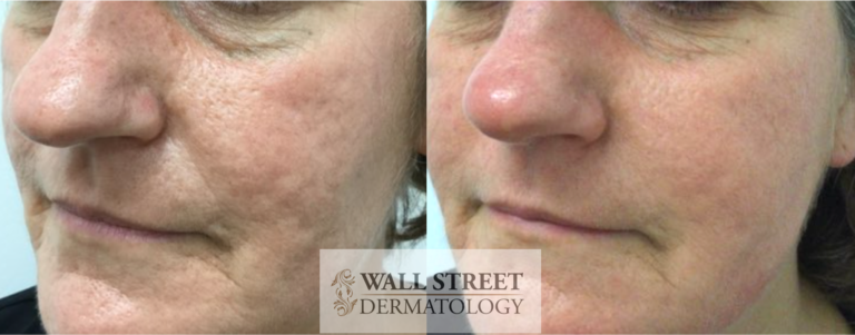 Acne Scar Subcision with Filler Before and After