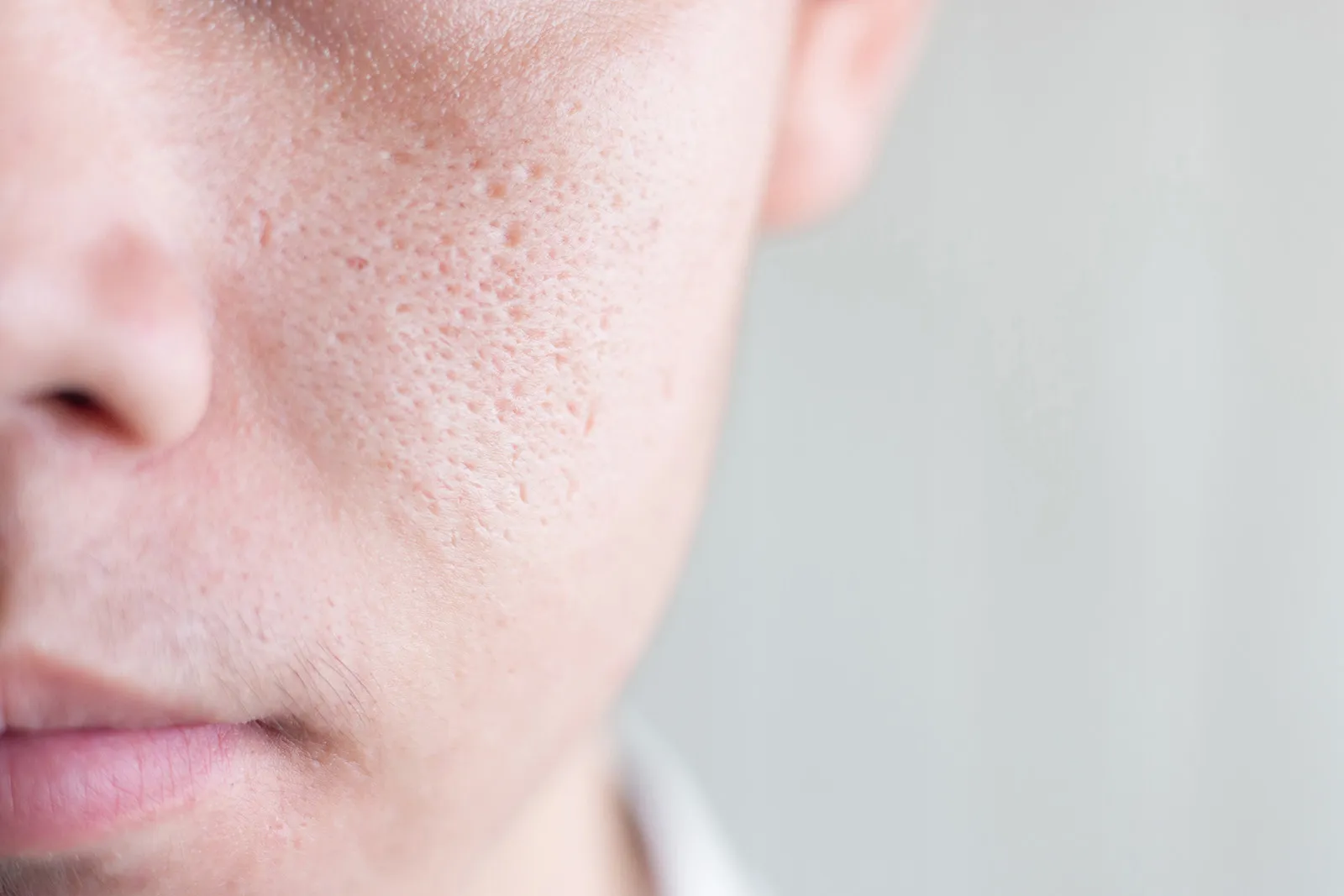 Reduce the Size of Large Pores from Acne & Oily Skin