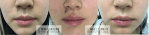 Surgical cosmetic mole removal before and after