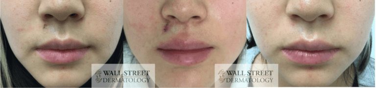 Surgical cosmetic mole removal before and after