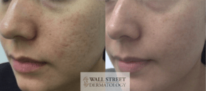 Acne Scar Subcision Before and After