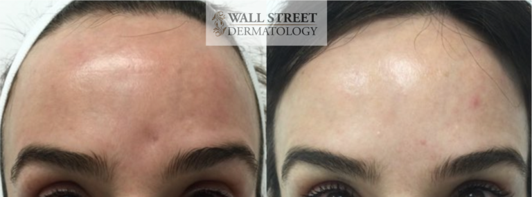 Before and After Acne Scar Subcision and Botox