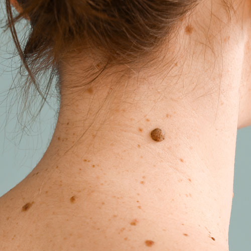 Does Mole Removal Leave A Scar?