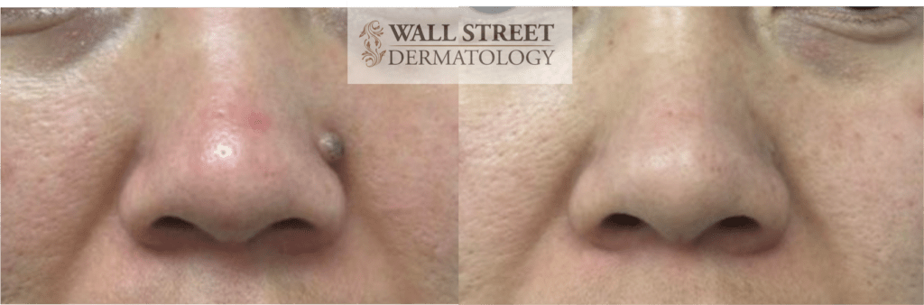 Cosmetic mole removal on nose before and after