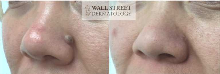 Cosmetic mole removal on nose before and after