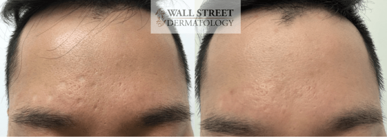 Before and After Acne Scar Subcision on Forehead