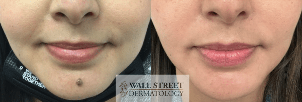 Surgical cosmetic mole removal before and after