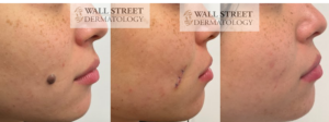 Before and After Cosmetic Surgical Mole Removal on Cheek
