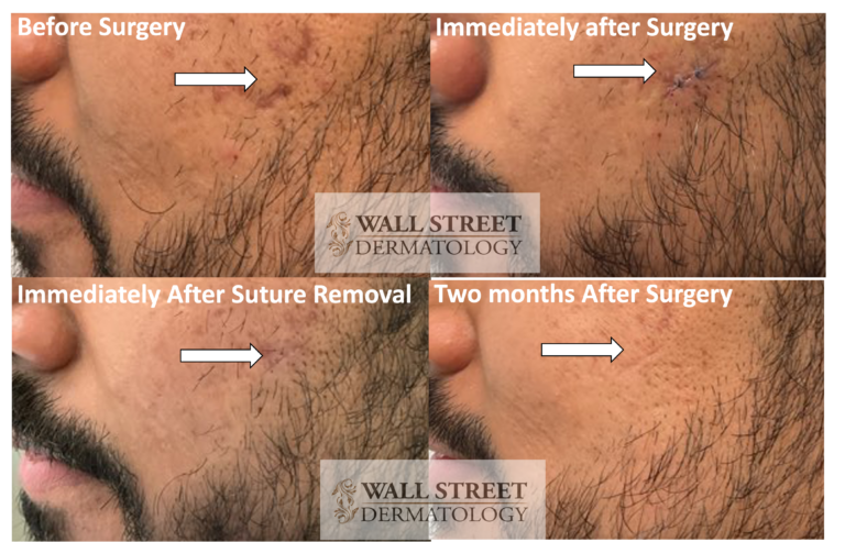 Surgical excision of a deep boxcar acne scar on the cheek by Dr. Julia Tzu at Wall Street Dermatology: before surgery, immediately after surgery, at suture removal, and two months after surgery