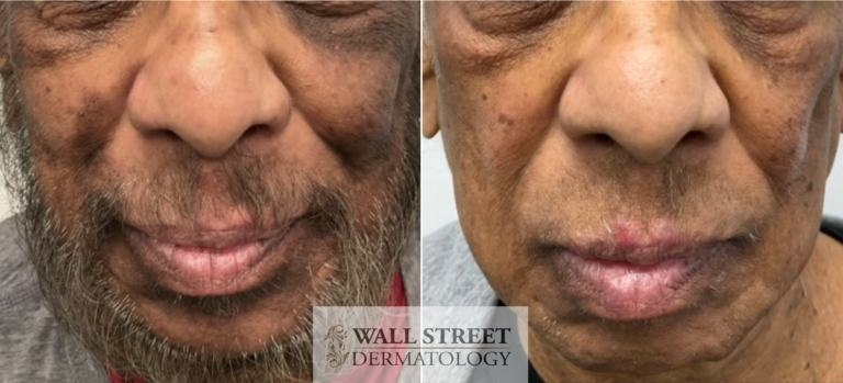 Before and after laser melasma treatment on darker skin, front view, by Dr. Julia Tzu at Wall Street Dermatology