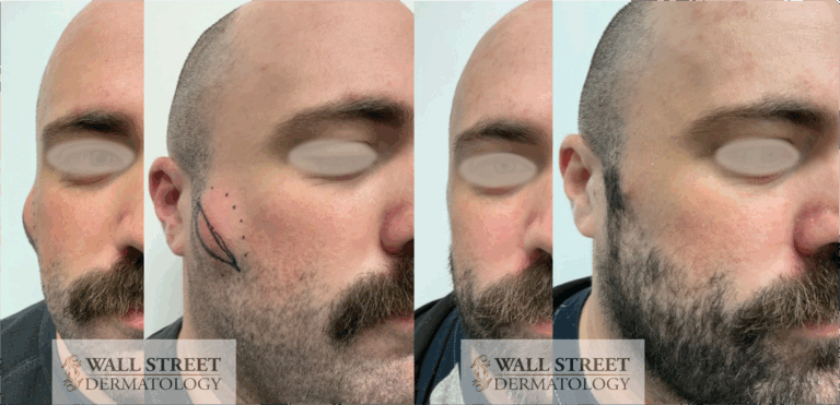 Before and after cosmetic cyst removal results by Dr. Julia Tzu at Wall Street Dermatology