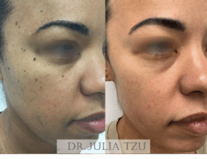 Before and After DPN Removal