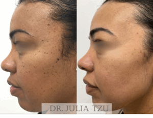 Before and After DPN Removal