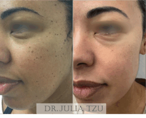 Before and After DPN Removal