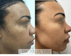 Before and After DPN Removal