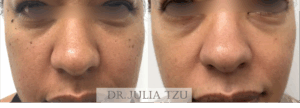 Before and After DPN Removal