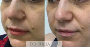 Before and After Cosmetic Mole Removal