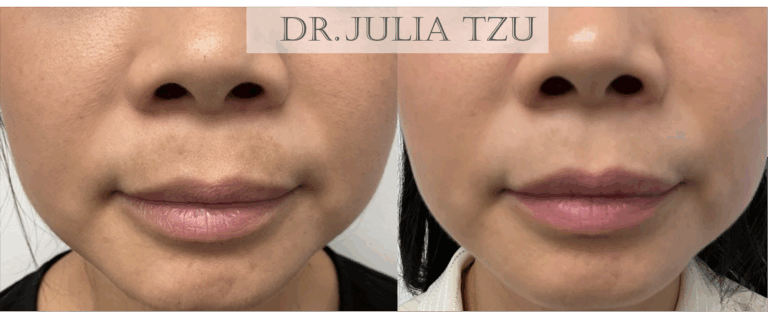 Before and after laser melasma treatment of the cheeks and upper lip, front view, by Dr. Julia Tzu at Wall Street Dermatology
