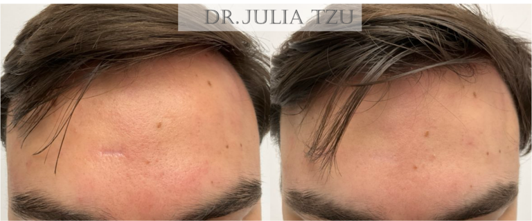 Before and after surgical scar revision of a forehead scar left by a mole removal performed elsewhere, by Dr. Julia Tzu at Wall Street Dermatology; after image at four months